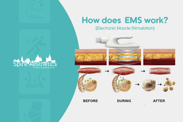 EMS treatment for post pregnancy weight loss treatment Faringdon