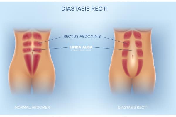 What Non-Surgical Options Are Available for Diastasis Recti Faringdon?