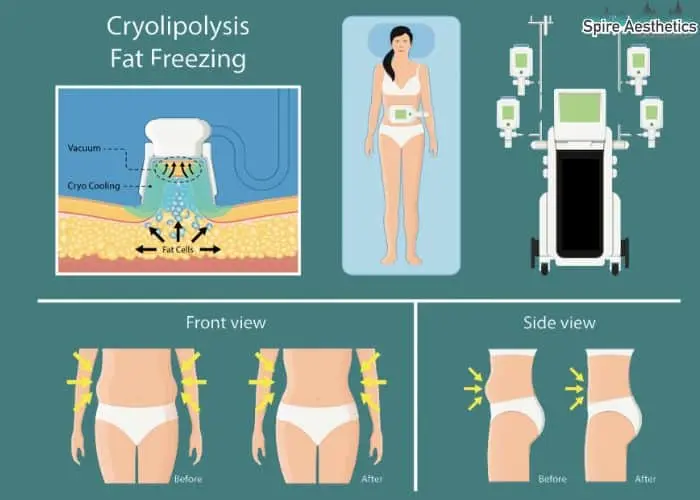 Fat freezing treatment Faringdon benefits for competitions to remove stubborn fat deposits.