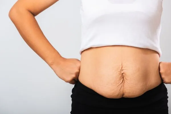 Image of a woman's stomach after weight loss with sagging skin following a gastric band Faringdon