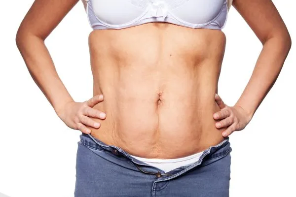 sagging skin on woman's stomach after weight loss injections Faringdon
