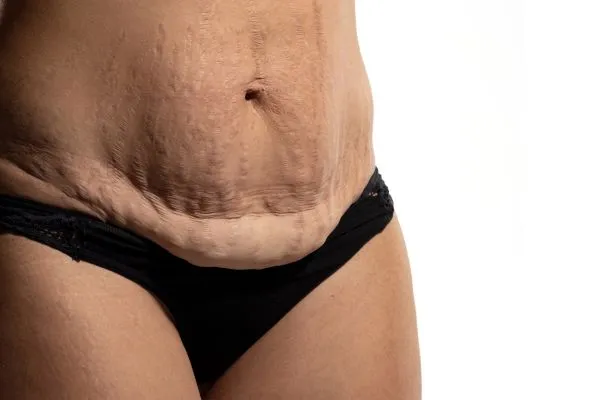 Image of womans stomach after weight loss injections Faringdon showing saggy skin