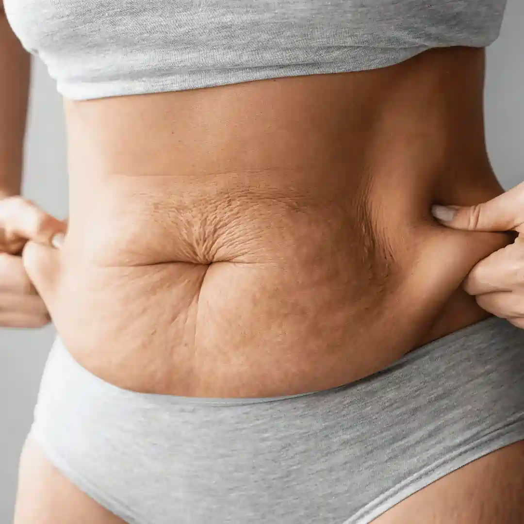 Is It Normal to Have Loose Skin After Pregnancy Faringdon?