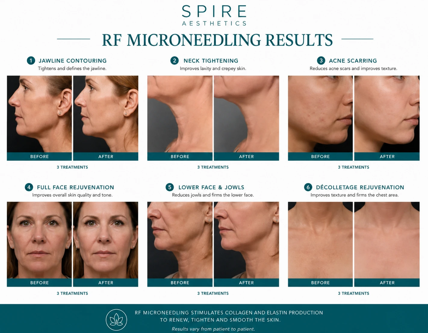 RF Microneedling Skin tightening Faringdon results