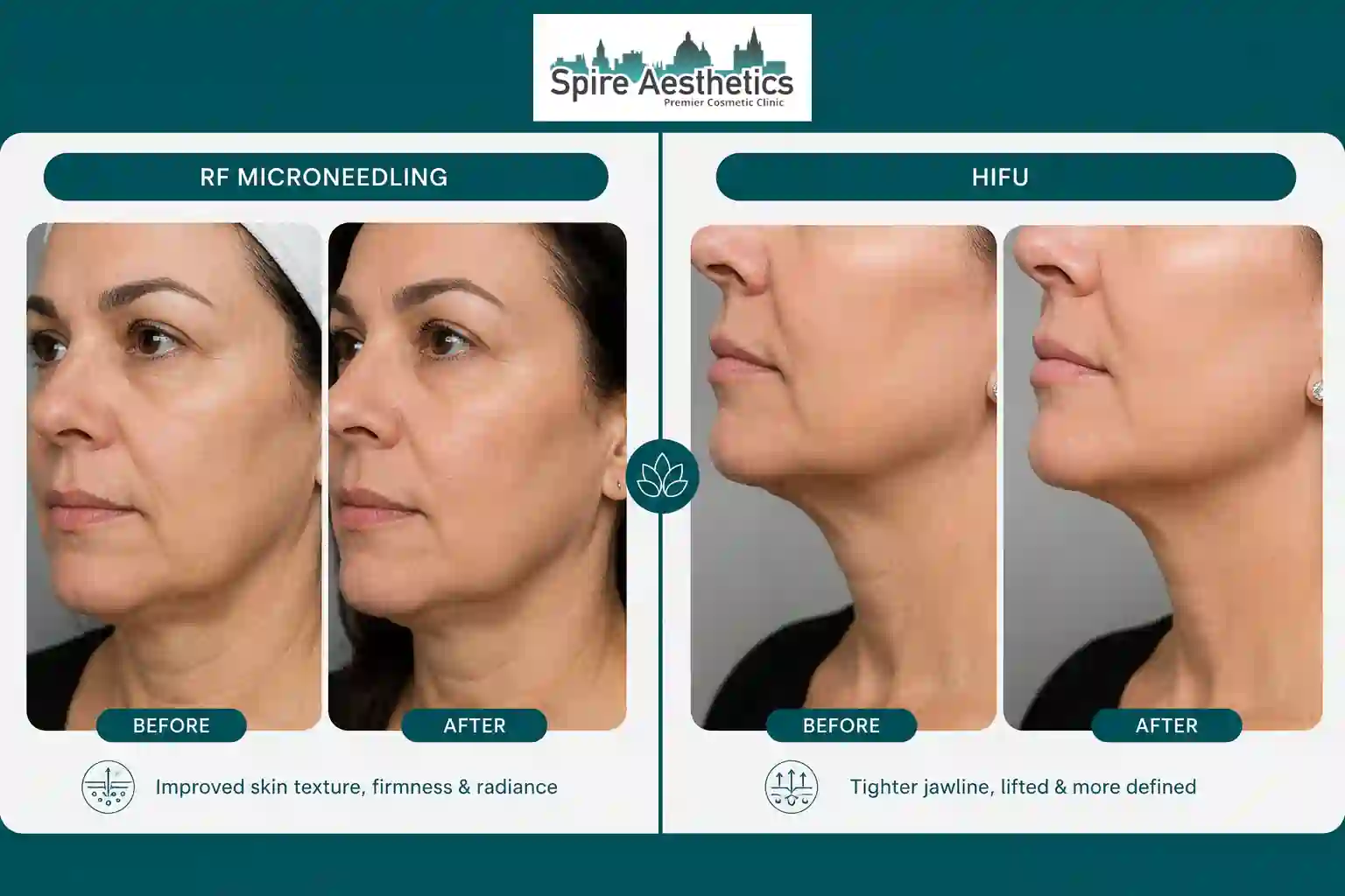 Can RF Microneedling and HIFU Be Combined Faringdon?