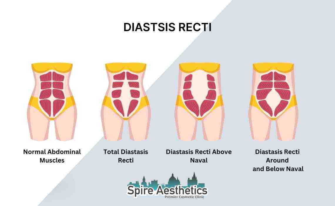 Is Non-Surgical Diastasis Recti Treatment Right for You? Common Concerns Answered Faringdon